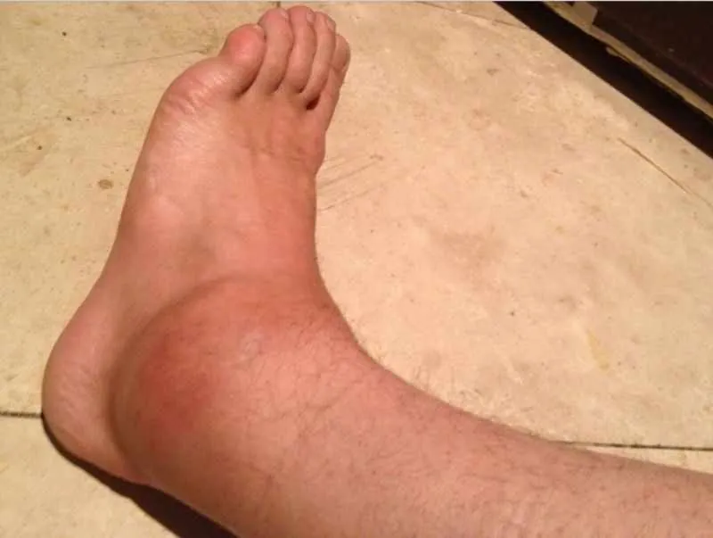 swollen ankle