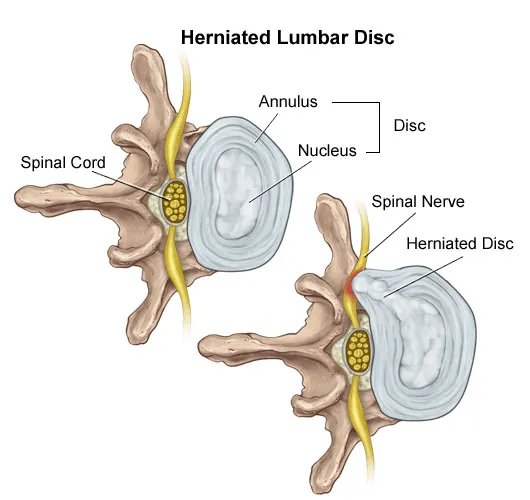 Lumbar Disc Bulge