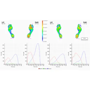 How Footscan Servicing Can Help with Foot and Ankle Pain — figure 4