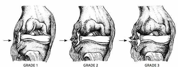 Ligament injury grades
