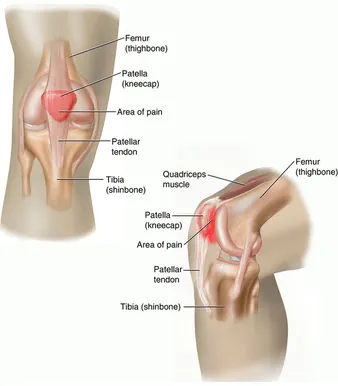 Squats – The King Of Exercises? — figure 2