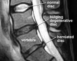 Squats – The King Of Exercises? — figure 3