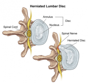 Lumbar Disc Bulge - Physio Lounge