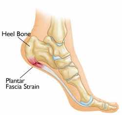 Plantar fasciitis anatomy