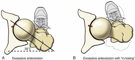 hip anteversion