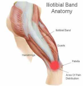 Iliotibial band syndrome, Bupa UK