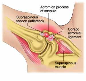 Shoulder impingement anatomy
