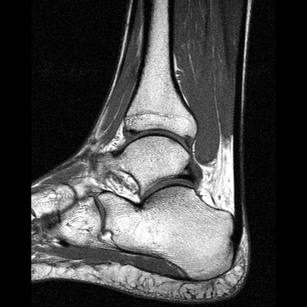 ankle MRI